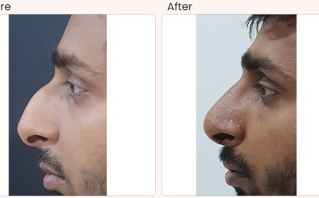 Nose surgery cost in Delhi - Dr Rajat Gupta