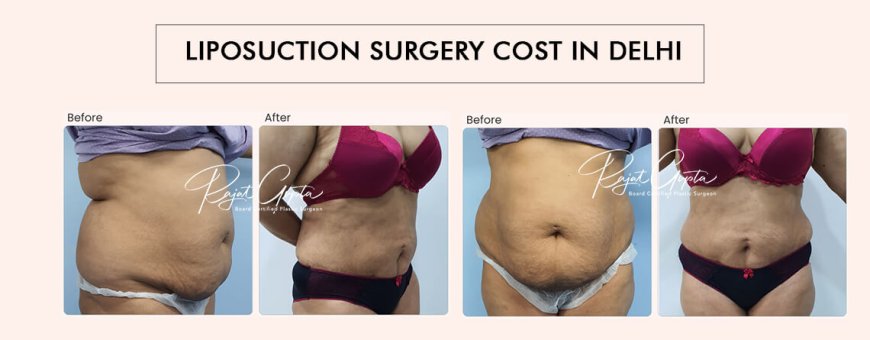 Liposuction Surgery Cost in Delhi: What’s Included and What’s Not