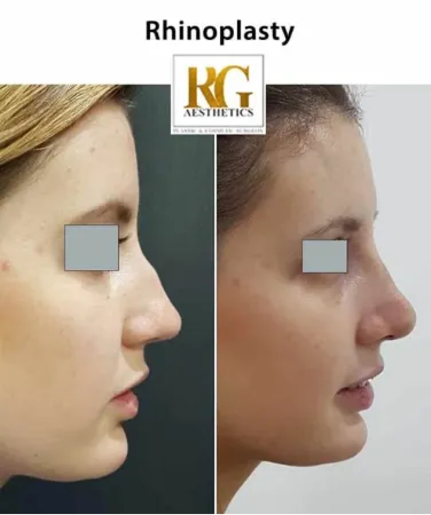 Rhinoplasty Surgery Before and After: Real Results and What to Expect