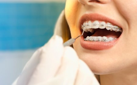 Types of Teeth Braces Treatment: A Simple Guide for Beginners