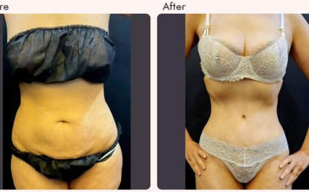 Tummy Tuck Surgery in Delhi - Dr Rajat Gupta