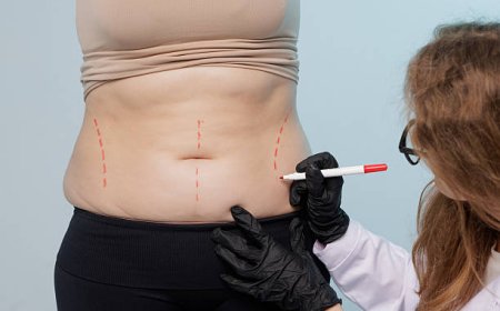 How Liposuction Procedure Defines Your Natural Curves