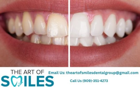 Dentist in Fontana CA | Emergency, Fillings & Wisdom Teeth Care