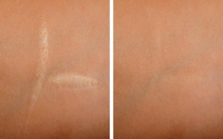 How Laser Scar Removal Helps Restore Skin Confidence