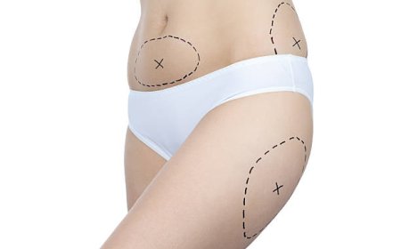 Achieve Firm Body with BodyTite Liposuction Tech