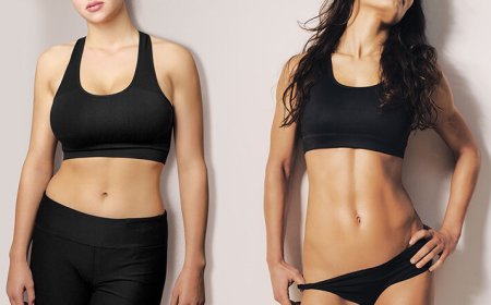 RG SHARP Technique for High-Definition Abdominoplasty