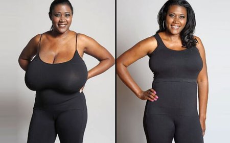 Flap Technique Surgery: Innovative Breast Reduction Surgery