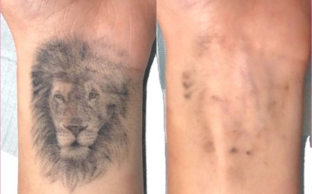 تقنية الليزر لإزالة الوشم دون التأثير على الجلد المحيط