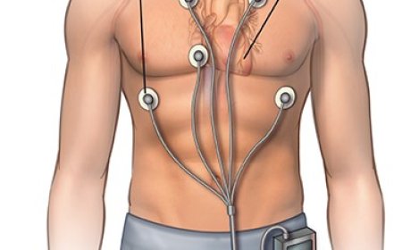 Book a Cardiac Holter Monitor Test in Mississauga for Early Heart Detection
