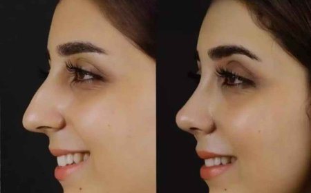 Nose Deviated Septum Surgery in Dubai: Precision Treatment for Nasal Obstruction