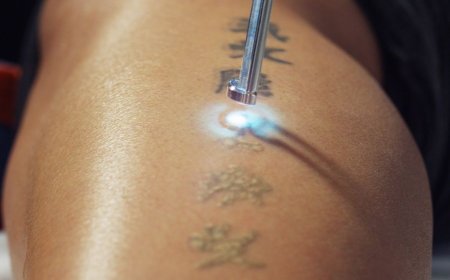 Laser Tattoo Removal for Stubborn Tattoos: What Works Best