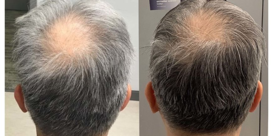 Your Complete Guide to Alma TED Hair Restoration: Is It Right for You?