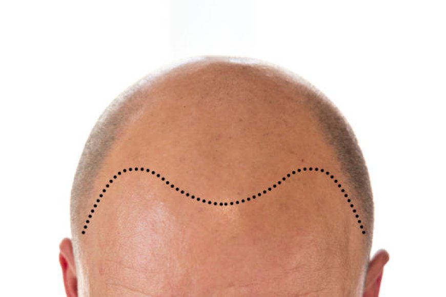 Hair Transplant Myths Busted: Facts vs. Fiction