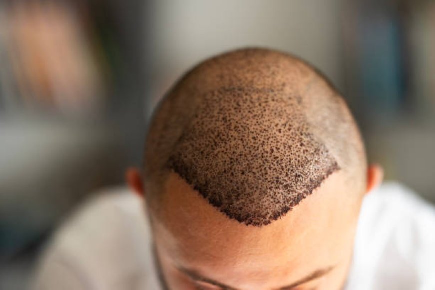 Hair Transplant Recovery Timeline and Tips
