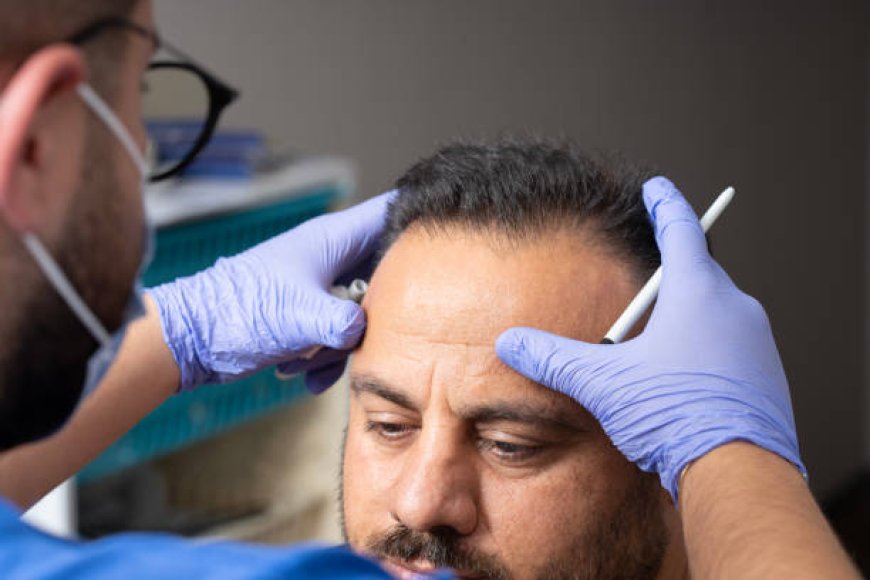 Maximizing Value from Hair Transplant Cost