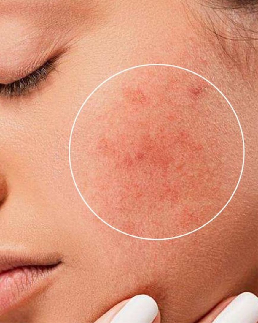 How Pigmentation Treatment in Riyadh Helps Achieve Clearer Skin