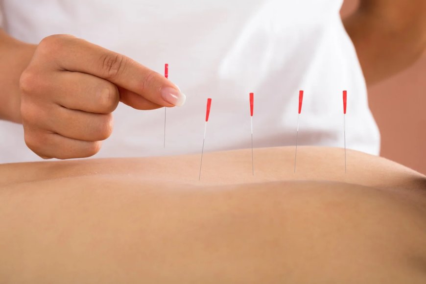 How Dry Needling Supports Faster Recovery in Sylvan Lake Physiotherapy