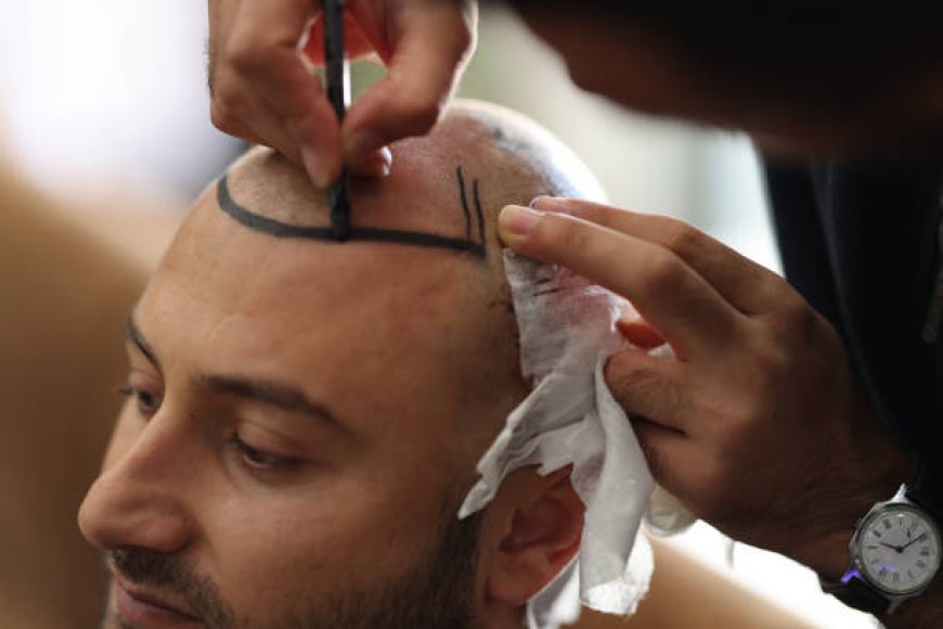 Hair Transplant for Scarred Scalp Areas