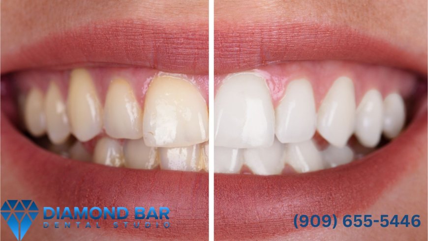 Best Dentist for Implants | Trusted Dentist in Diamond Bar CA