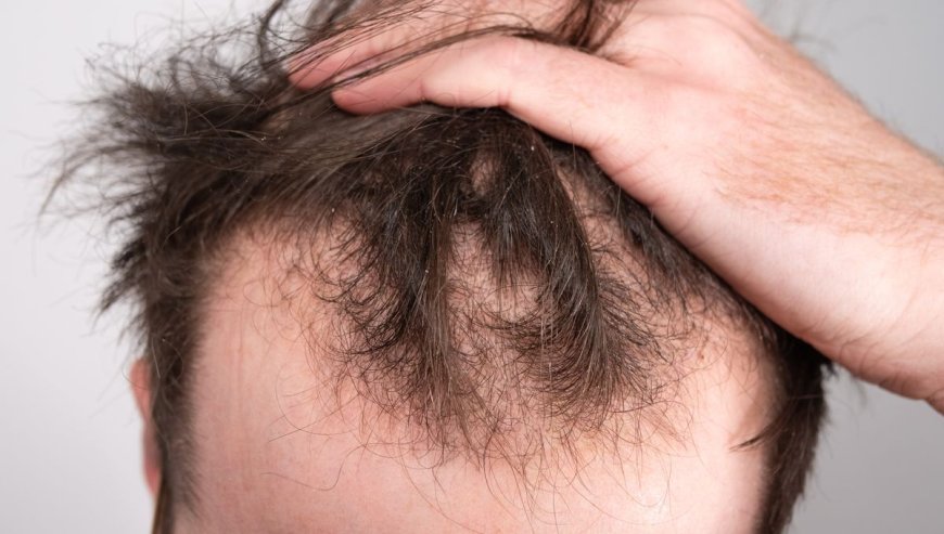 What Results Can You Expect from FUE Hair Transplant Treatment?