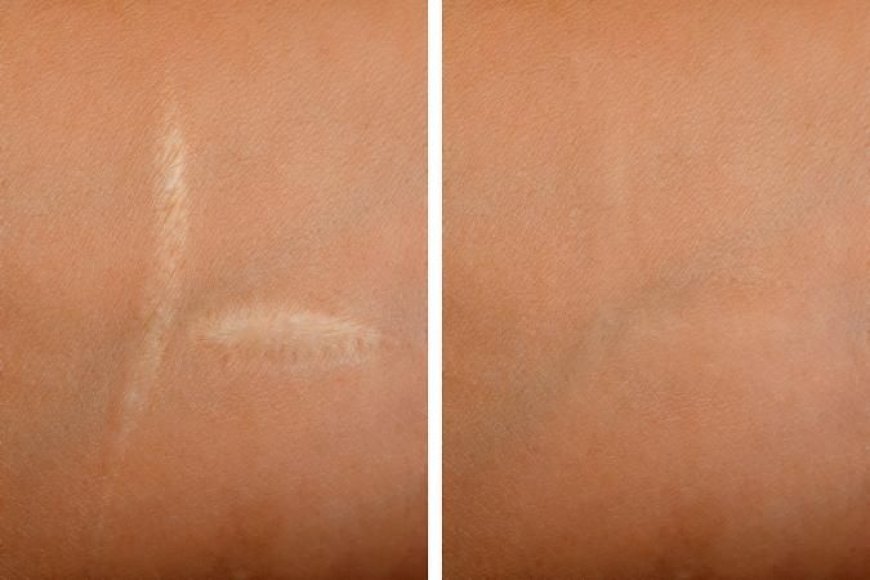 How Laser Scar Removal Helps Restore Skin Confidence