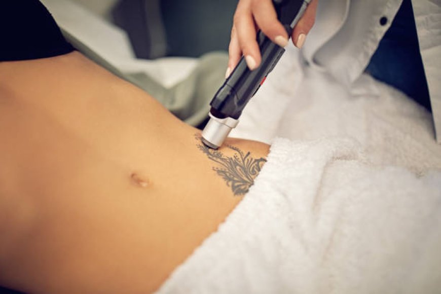 Laser Tattoo Removal: Fade Ink Safely Completely