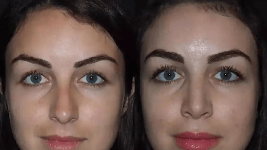 Rhinoplasty in Dubai Offering Advanced Nose Reshaping Solutions