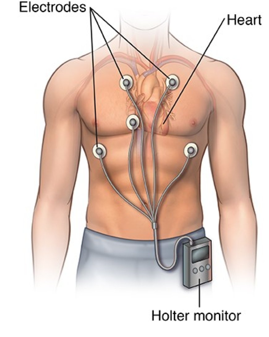 Book a Cardiac Holter Monitor Test in Mississauga for Early Heart Detection
