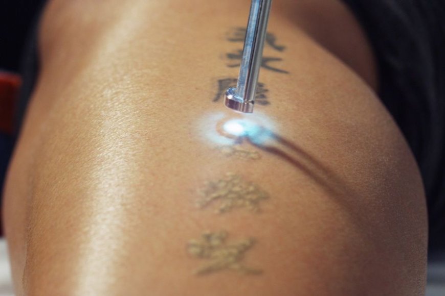Laser Tattoo Removal for Stubborn Tattoos: What Works Best