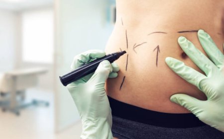 Liposuction Procedure Techniques: Laser vs Traditional Methods