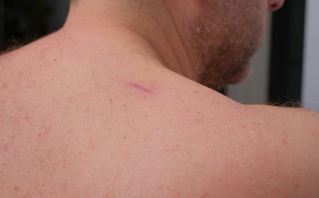 Laser Scar Removal in Riyadh: A Complete Guide to Smoother, Clearer Skin