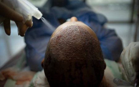 Hair Transplant Post Gene Therapy: Scalp Synergy Optimization