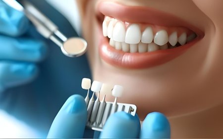 Top Questions Before Dental Veneers Treatment | The Dental Roots