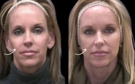 Sculptra in Dubai for People on Keto or Ozempic