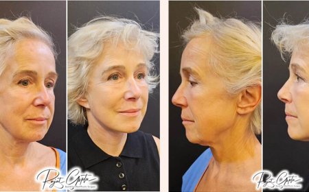 Schedule Facelift Surgery Consultation with Certified Surgeons
