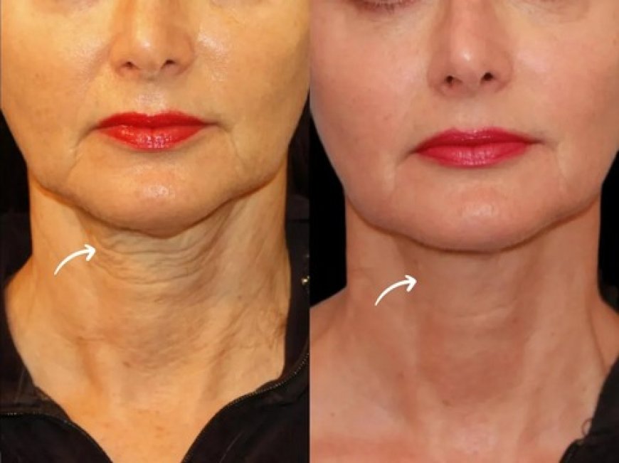 Best Plastic Surgeon in Dubai: Sculptra Skin Anatomy