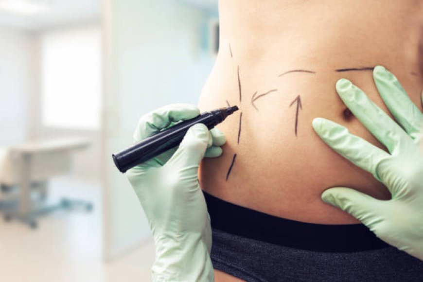 Liposuction Procedure with AI Mapping: Precision Fat Targeting