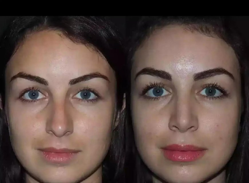 Is Nose Surgery in Dubai Right for You?