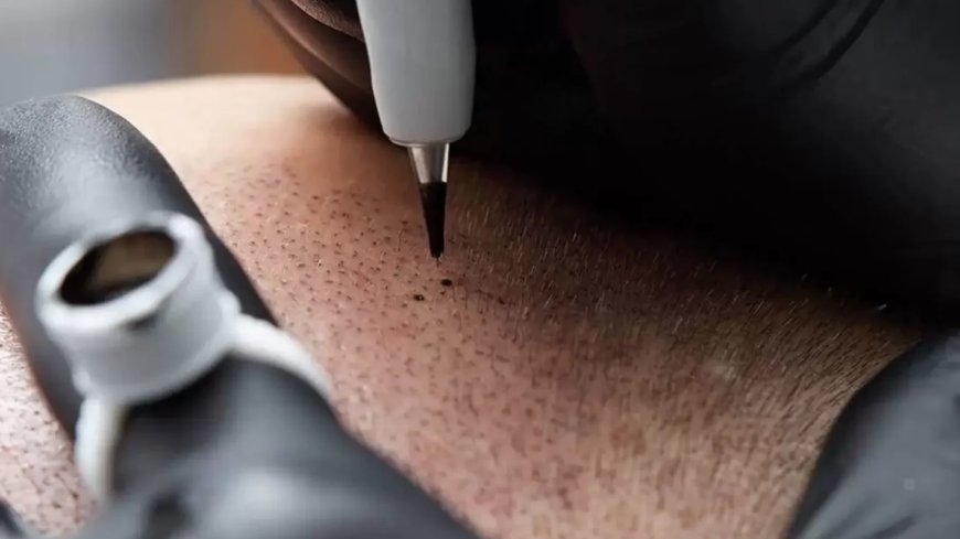 What Is a Hair Tattoo for Hair Loss and How Does It Work?