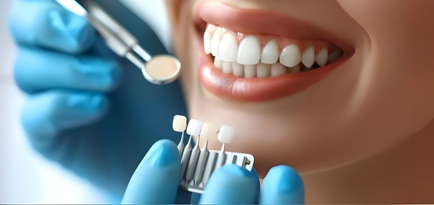 Top Questions Before Dental Veneers Treatment | The Dental Roots