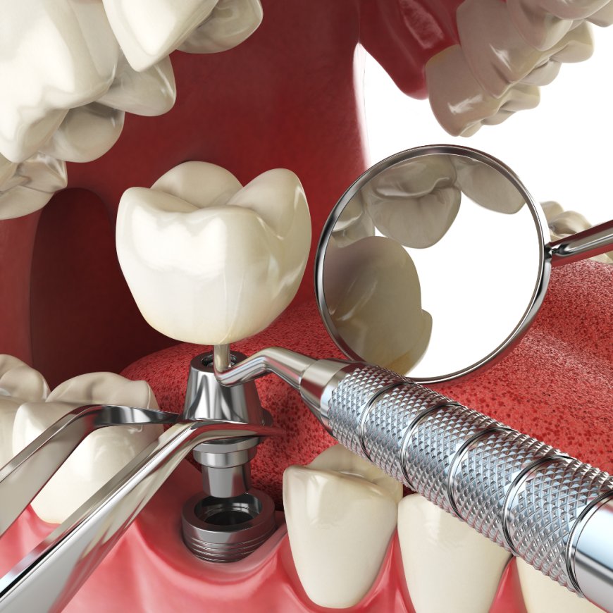 Choosing Single Tooth Implants in Dubai: Key Considerations