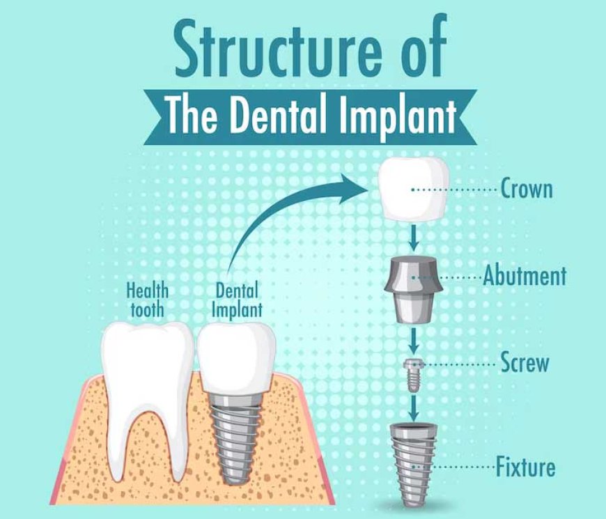 Single Tooth Implant Cost in Dubai – A Simple Guide